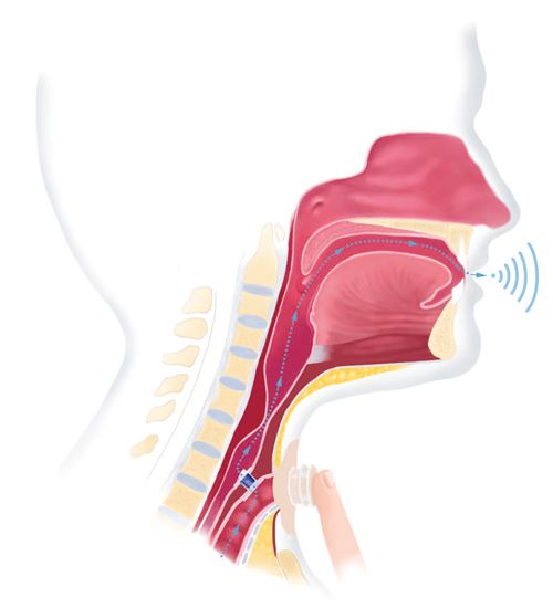 Health & Body - Voice prostheses: enabling speech after surgical larynx removal