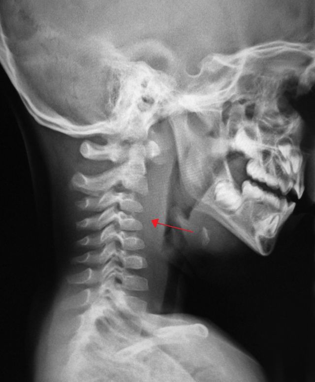 Health & Body - Retropharyngeal abscess: deep tissue infection in the throat