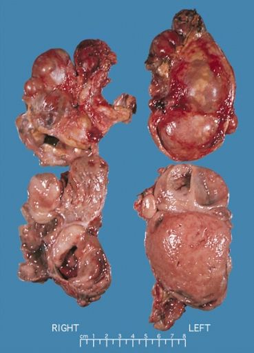 Health & Body - MEN2: diagnosing inherited tumors of the endocrine system